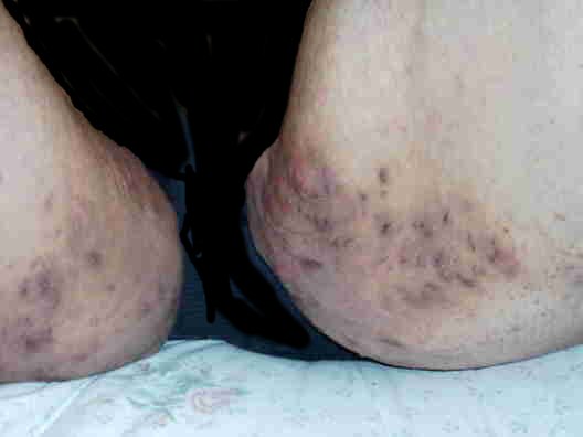 Pictures of Boils: Symptoms, Causes, Treatments, and More