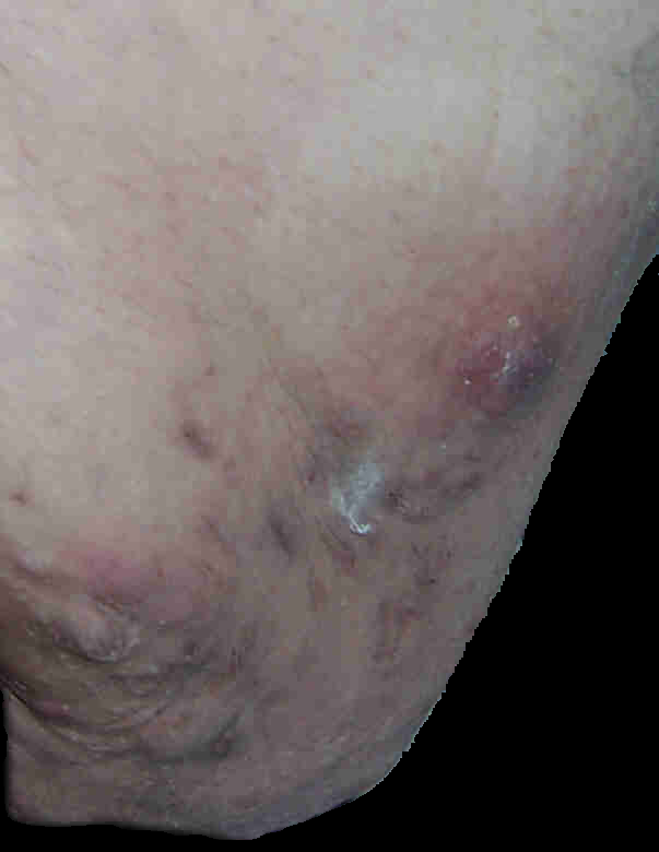 Is this hiradenitis? Having boils come and go on my inner thighs for years  now : r/Hidradenitis